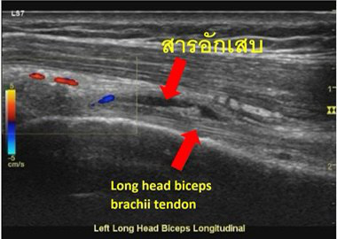 ภาพแสดงเอ็นกล้ามเนื้อข้อไหล่ (Long head biceps tendon) 