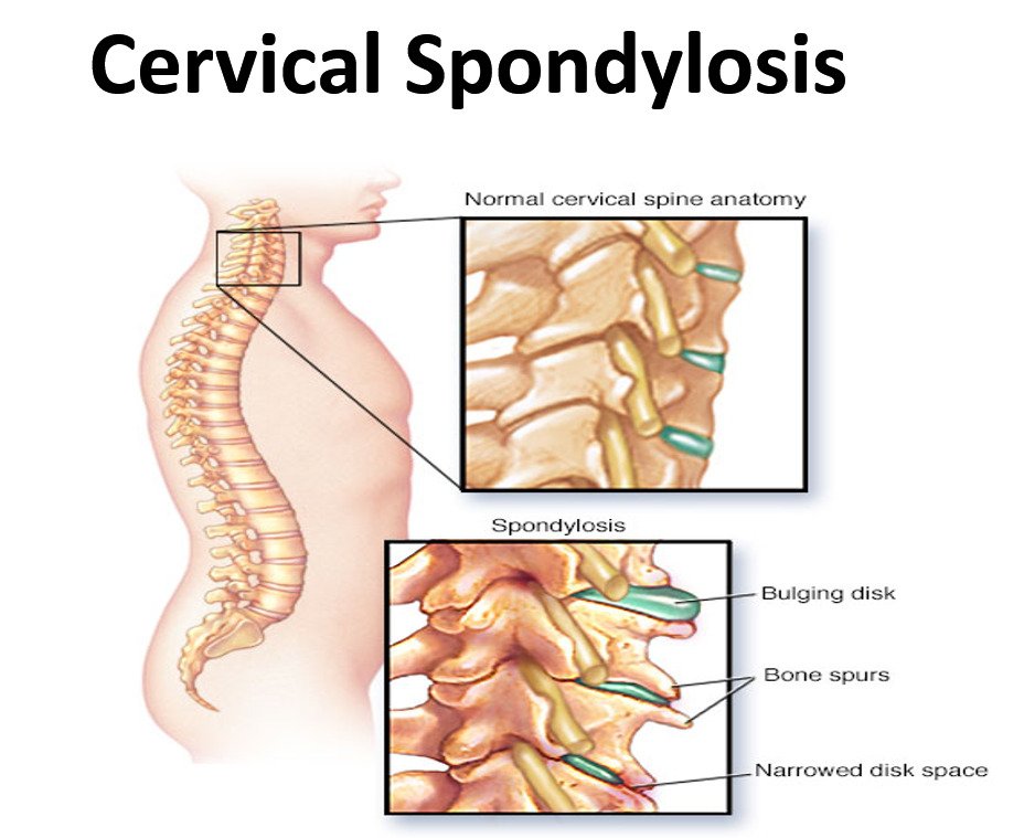 โรคกระดูกคอเสื่อม (Cervical Spondylosis)