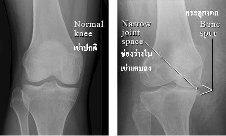 ภาพ X ray ข้อเข่าเปรียบเทียบระหว่างข้อเข่าปกติ (ภาพซ้าย) และข้อเข่าเสื่อม (ภาพขวา)