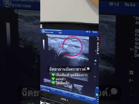 Preview image for the video "รีวิวรักษาอาการปวดเข่า เข่าเสื่อม มีเสียงในข้อเข่า".
