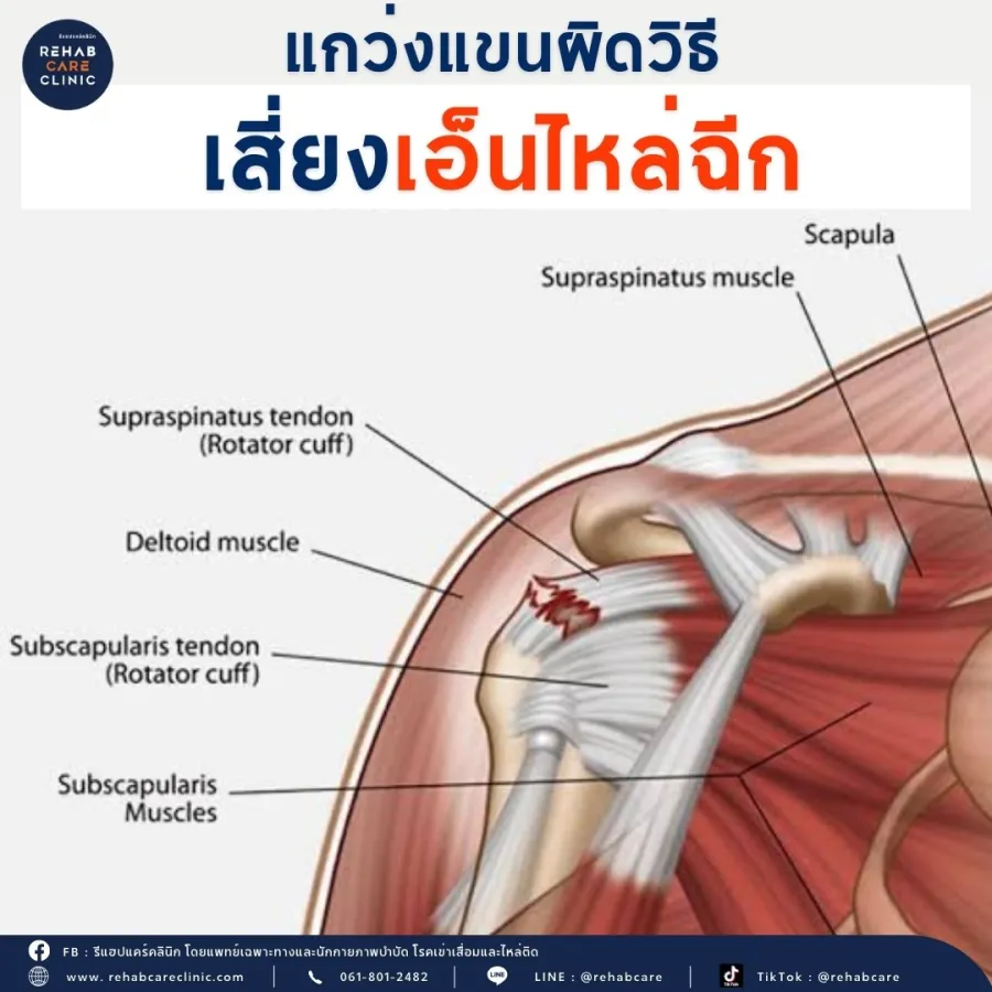 แกว่งแขน ท่าออกกำลังกายยอดฮิต เสี่ยงเอ็นไหล่ฉีกได้
