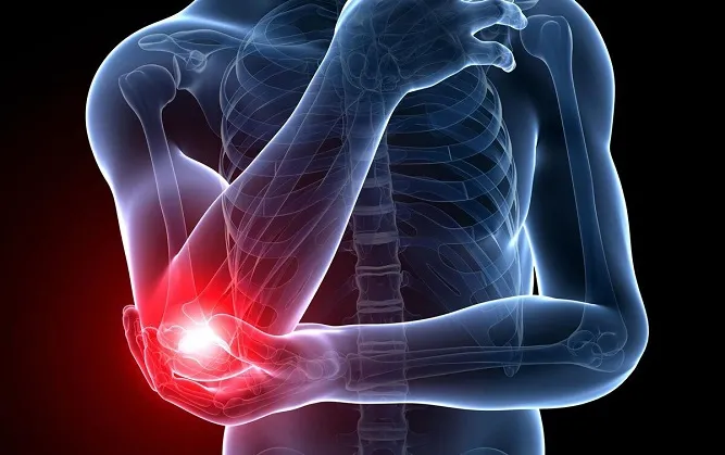 TENNIS ELBOW ปวดศอกด้านนอก อาการที่ไม่ได้เกิดขึ้นเฉพาะกับนักเทนนิส
