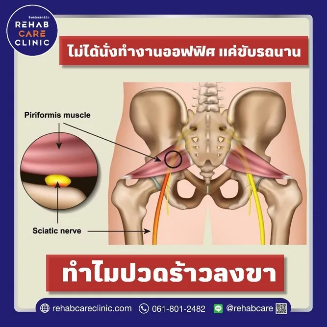 ไม่ได้นั่งทำงานออฟฟิศแต่ขับรถนาน ทำไมปวดร้าวลงขา และมีวิธีแก้ไขป้องกันยังไง