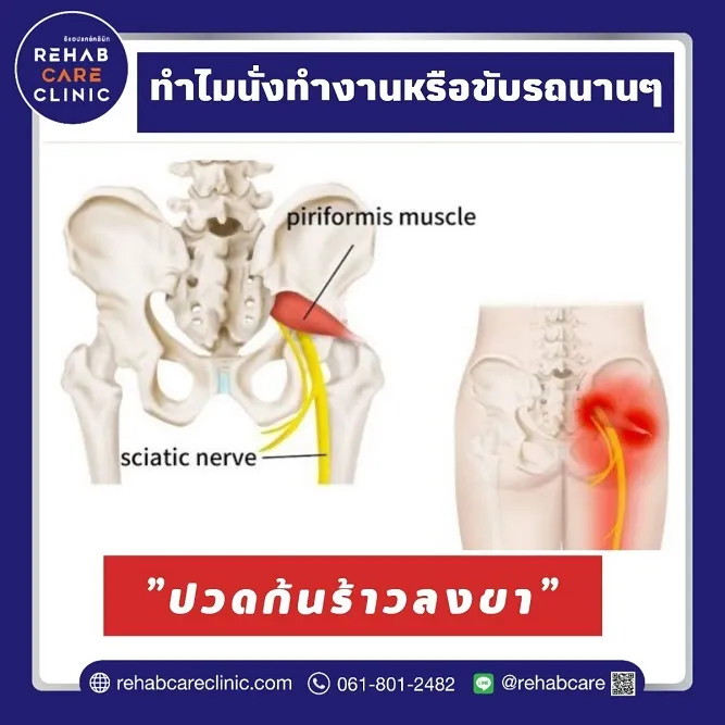 ทำไมนั่งทำงานหรือขับรถนานๆแล้วถึงปวดก้นร้าวลงขา?