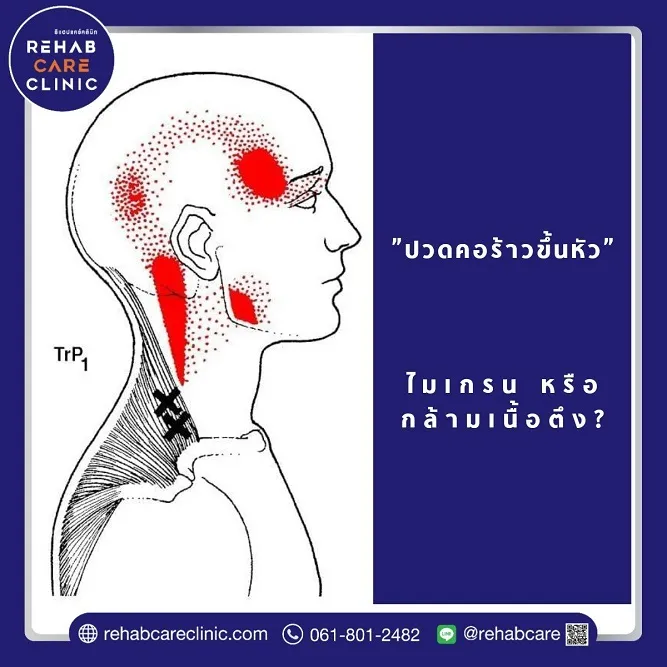 ปวดคอร้าวขึ้นหัว เกิดจากไมเกรนหรือกล้ามเนื้อตึงกันแน่?