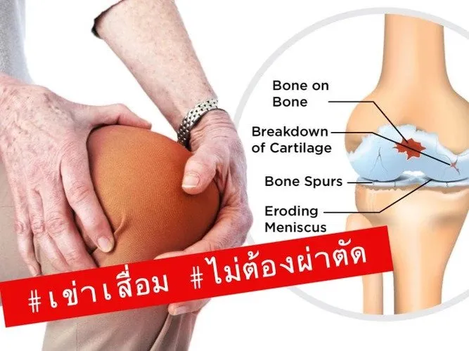 โรคข้อเข่าเสื่อมคืออะไร ถ้าเป็นแล้วต้องผ่าตัดหรือไม่ และถ้าไม่อยากผ่าตัดต้องทำอย่างไร